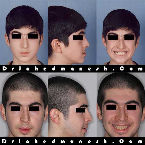 سن ارتودنسی محدوده سن درمان ارتودنسی